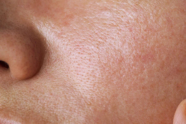 peau grasse pores dilatés