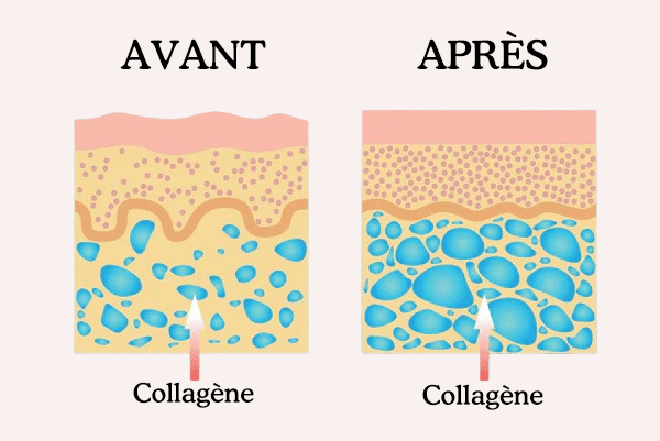 collagène avant apres sur la peau graphique visuel