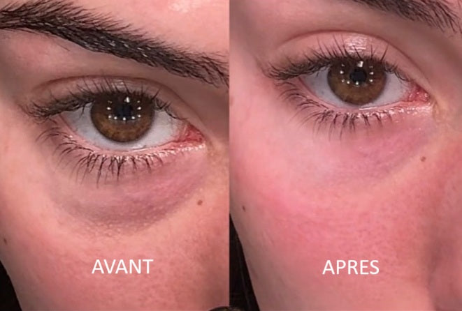 avant après contour des yeux femme patches escargot